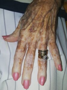 Nurse takes photo of old lady’s hand – then sees detail in the picture..