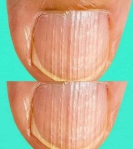 Having Striped Nails Could Mean That Your Body Is…- Here’s What It Is